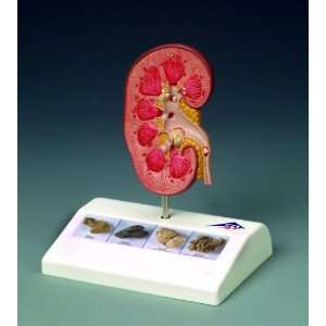 Lippincott Williams + Wilkins Kidney Stone Model  
