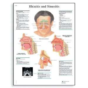   Sinusitis Anatomical Chart, French), Poster Size 20 Width x 26
